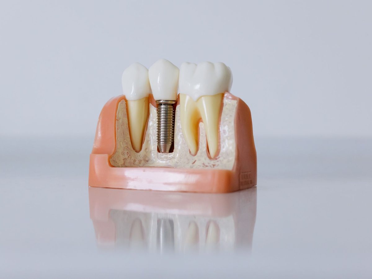 A model of a dental implant with its crown
