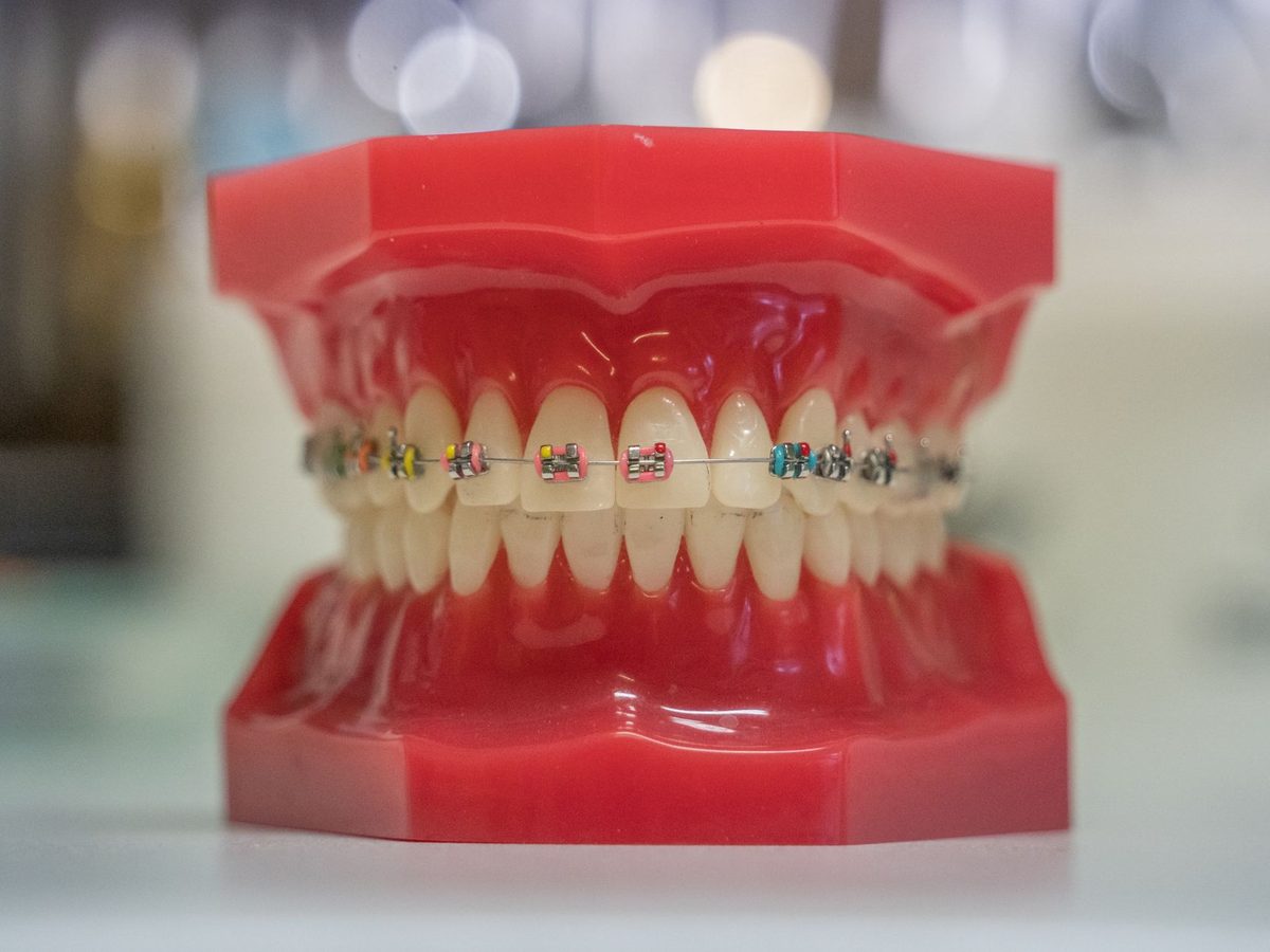 A dental model with braces